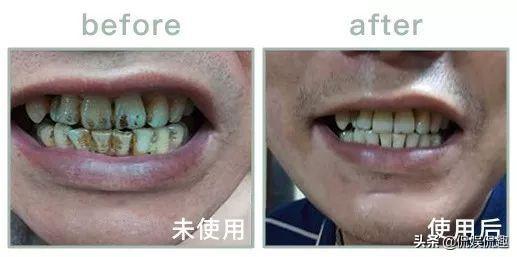 刷牙时一个小窍门彻底告别黄臭牙,刷牙的时候放点小苏打牙会变白吗