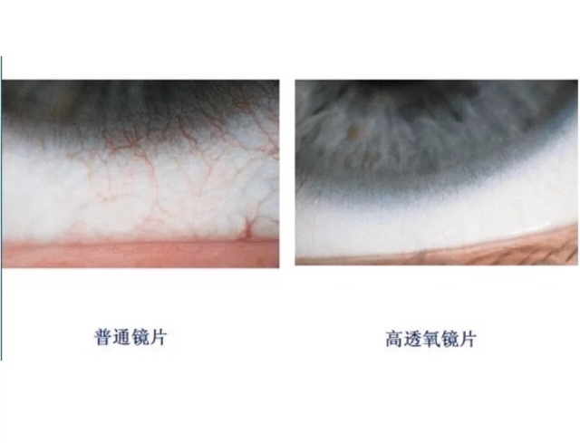 隐形眼镜大扒皮(三)购买佩戴各种问题