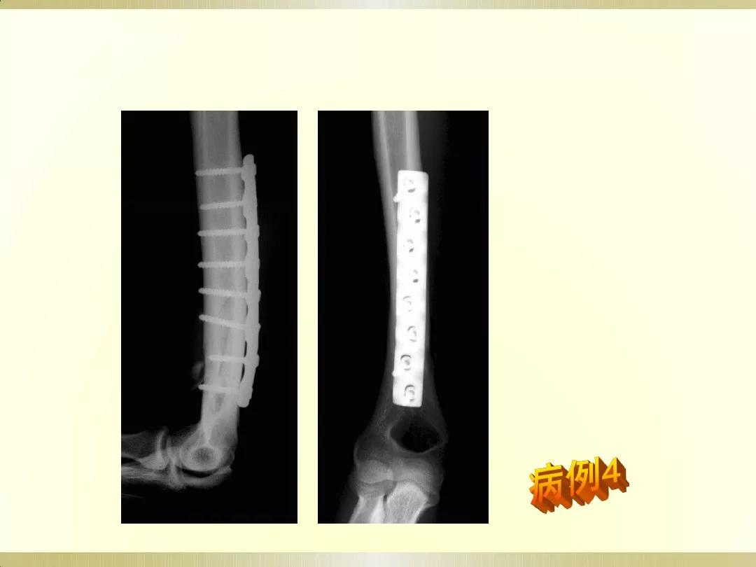 骨科x光片读片技巧,放射科骨科读片教程