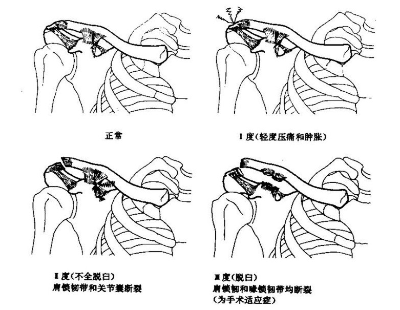肩膀疑似脱位但是ct显示正常,肩关节脱位术后又翘起来了