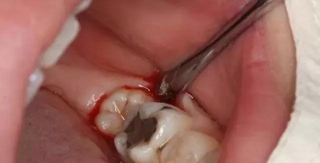 拔牙打麻药会影响恒牙的发生吗,拔牙时打麻药会不会引起口腔溃疡