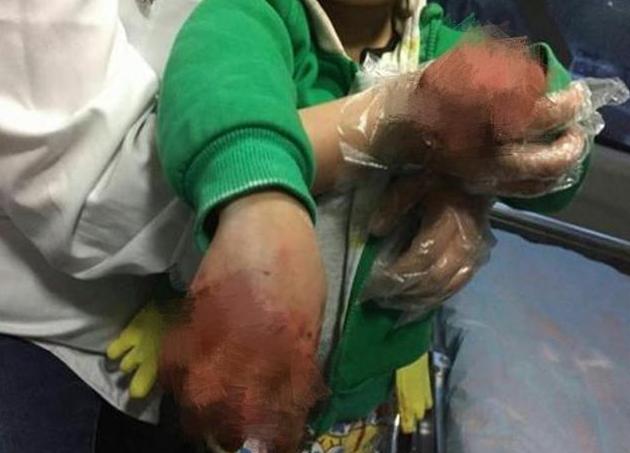 小孩不小心把手伸进煤气灶烫到了,开水烫伤婴儿手怎么处理