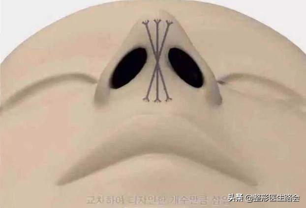 线雕鼻做了好看吗,鼻子短做线雕隆鼻好看吗