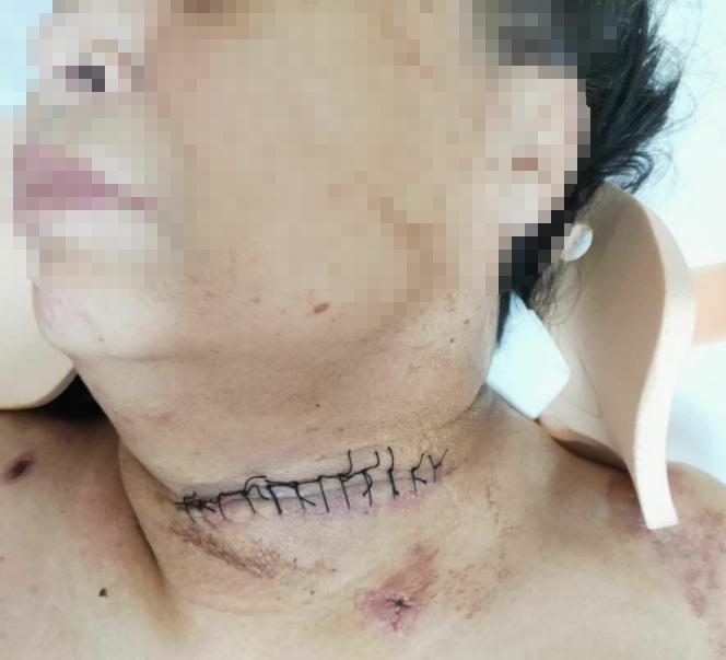 颈椎术后脑脊液漏取什么体位,脊髓型颈椎病手术后植骨愈合时间