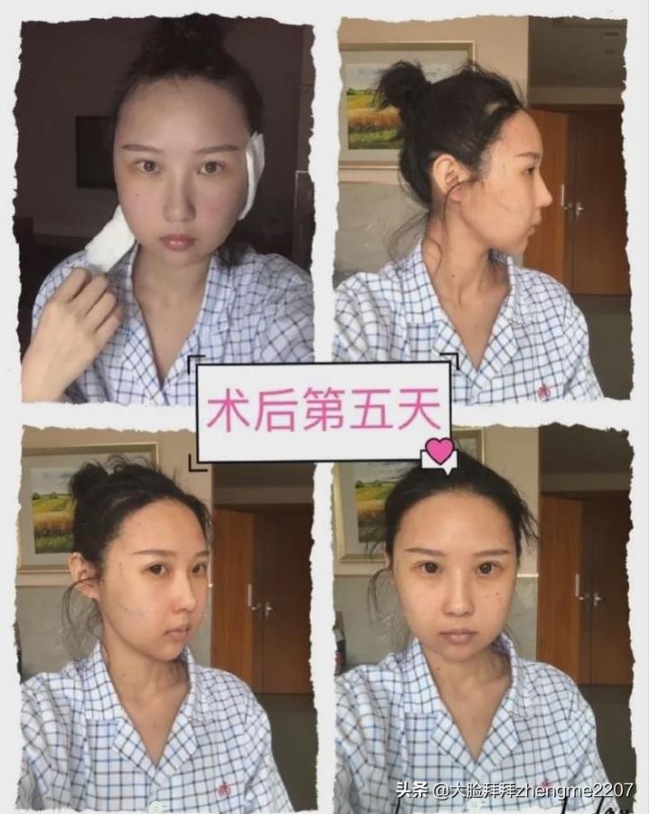 颧骨颧弓内推手术全过程真人,颧骨内推颧弓手术恢复全过程分享