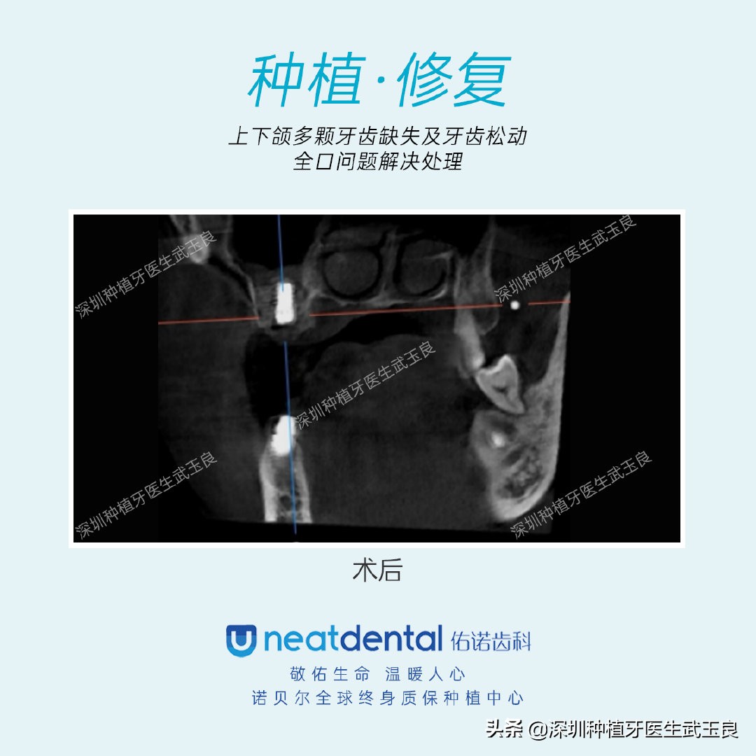 多颗牙齿缺失怎么修复全过程,多颗缺失牙修复案例