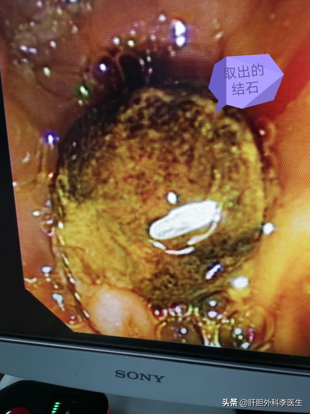 胆囊结石92老人建议做手术吗,九十多岁的老人胆管结石怎么办