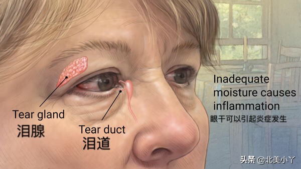 眼科医生3个忠告缓解干眼症,干眼症怎么解决眼科专家来告诉你