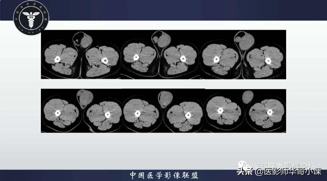 [精品课件]畸胎瘤及精原细胞瘤（*丸睾**肿瘤及肿瘤样变CT及MR表现）