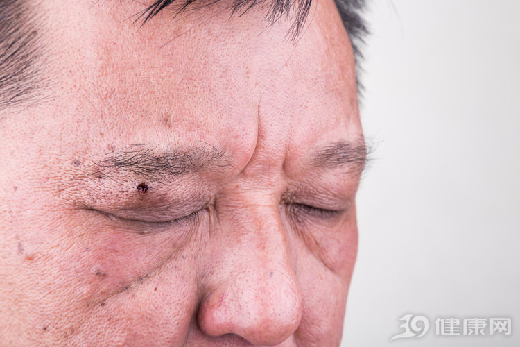 鑴氬簳鐥ｇ檶鍙樼殑琛ㄧ幇,榛戣壊鐥ｇ檶鍙樼殑琛ㄧ幇