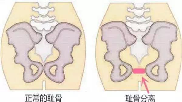 女人生孩子是顺产好还是剖腹生好,为什么说女人生孩子是鬼门关