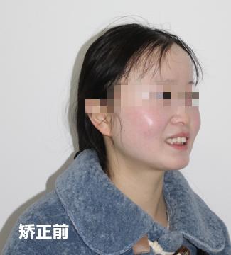 南京牙齿矫正内倾,南京牙齿矫正比较好的医院有哪些