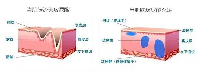 揭秘水光针不止能补水,水光针的真实效果