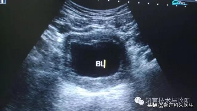 特殊性膀胱炎超声表现,特殊性膀胱炎吃什么药