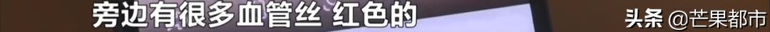 身上长这3种痣要警惕,身体上有这种痣要当心