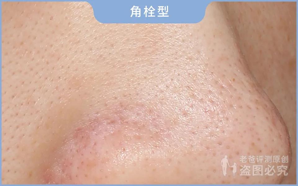 正确科学的去黑头方法一次说清楚,正确的去黑头的方法在这里