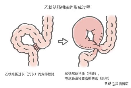 乙状结肠扭转原因,乙状结肠扭转病例
