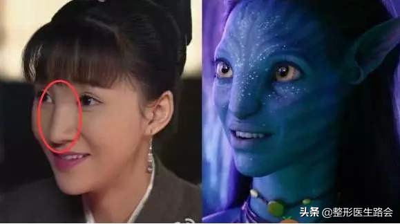 玻尿酸填充鼻子后悔了,玻尿酸注射后悔打溶解酶会不好吗