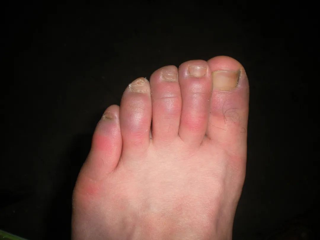 喝酒后冻死是怎么回事,喝酒第二天发冷发热是怎么回事