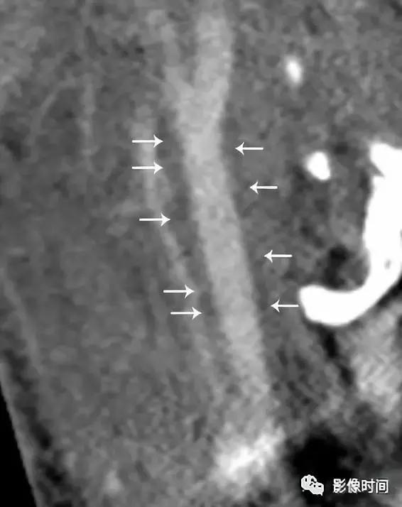 双侧颈动脉鞘间隙多发小淋巴结影,双侧颈动脉间隙多软组织密度结节
