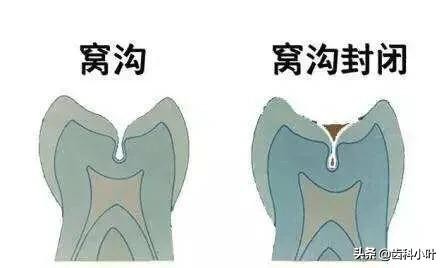 儿童牙常见问题,牙齿常见儿童牙病