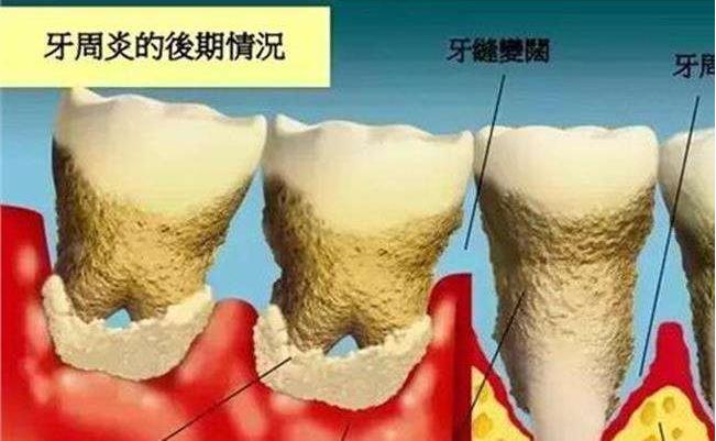 牙龈萎缩牙齿松动怎么挽救,牙龈萎缩牙齿松动严重怎么处理