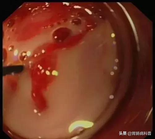 阑尾炎最新内镜微创手术,内镜下阑尾炎治疗术哪里可以做