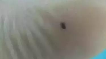 点痣医生,医院医生点痣视频