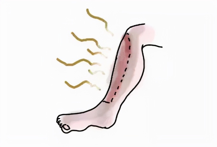 老烂腿皮肤坏死怎么治,老烂腿溃烂用什么药膏