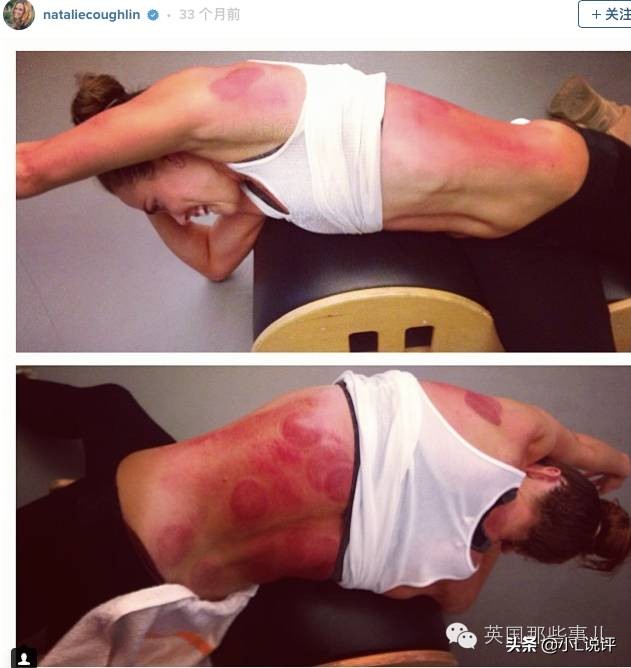 来自东方的神秘力量，让老外痴迷的拔火罐和蚊帐