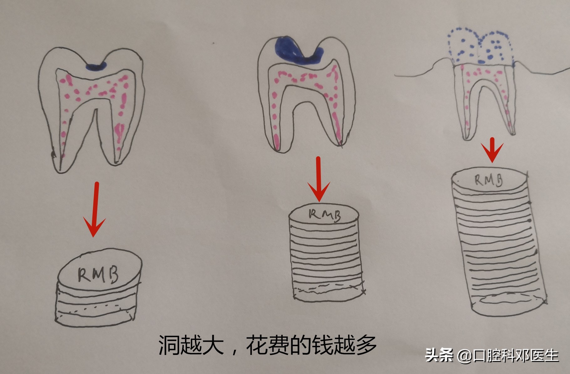 上排虫牙补牙全过程,虫牙补牙疼怎么办