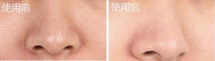 去黑头粉刺最好的建议,真正有效祛黑头粉刺