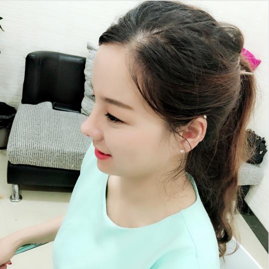 网红鼻子修复效果图,鼻整形多久可以修复