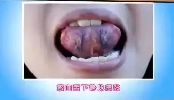 瘀血症中药化瘀的原理,活血化瘀的瘀血从哪排出