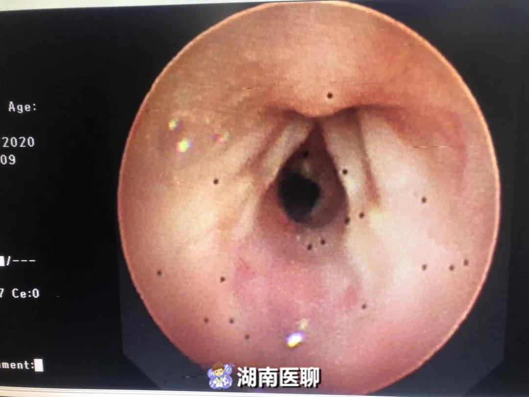 新生儿男孩胸口小肉粒,小婴儿出生喉咙有个洞有什么影响