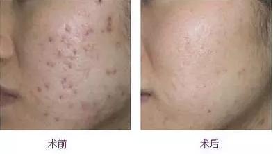 鍋氱編瀹瑰幓姣涘瓟绮夊埡榛戝ご鐥涘悧,鍋氱編瀹圭鐥樺潙