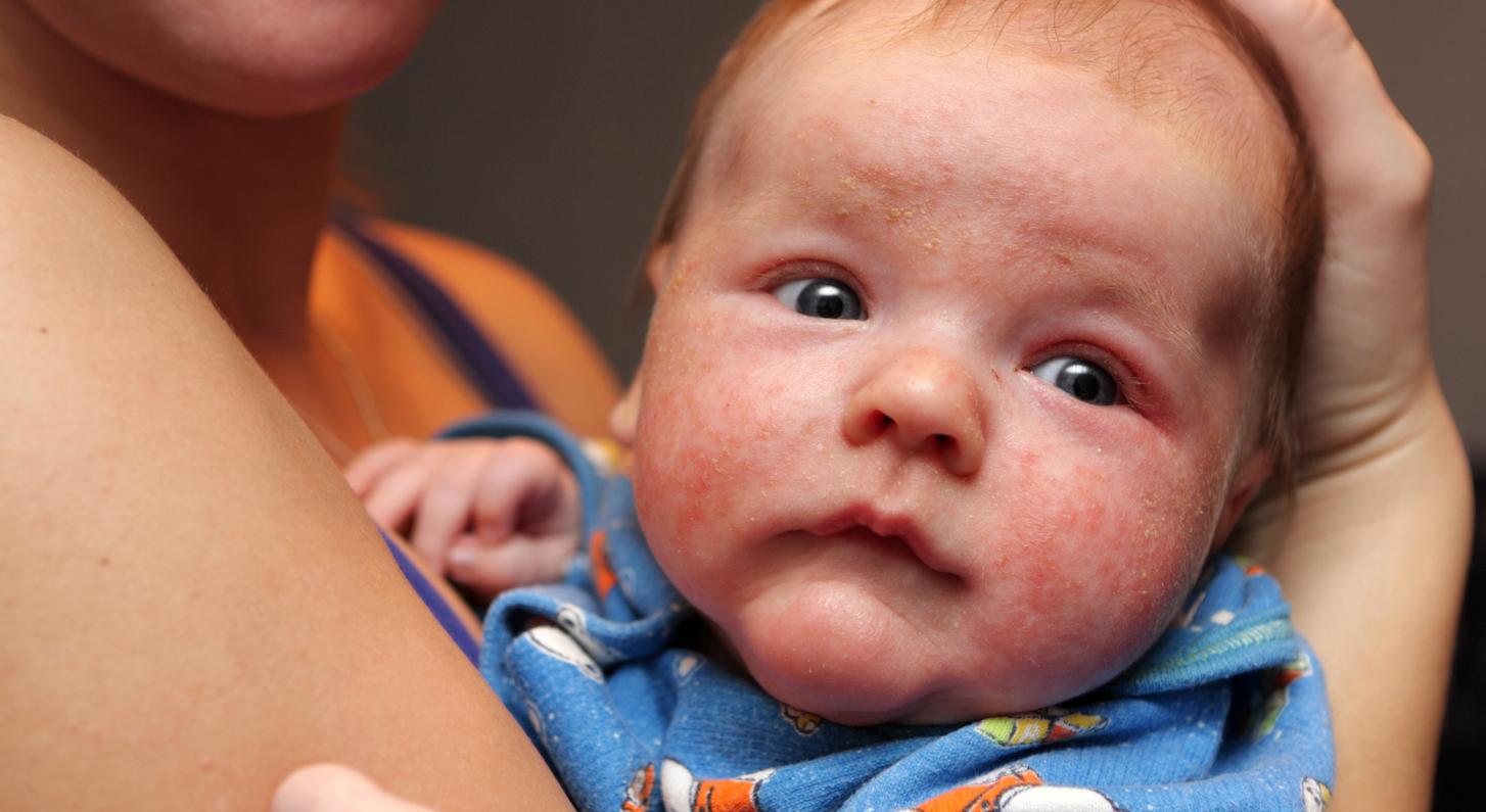 婴儿湿疹可以擦激素的药膏么,治疗宝宝湿疹不含激素的药膏