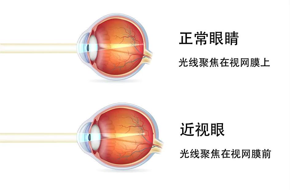 为什么裸眼视力1.0近视200度,视力1.0相当于近视多少度