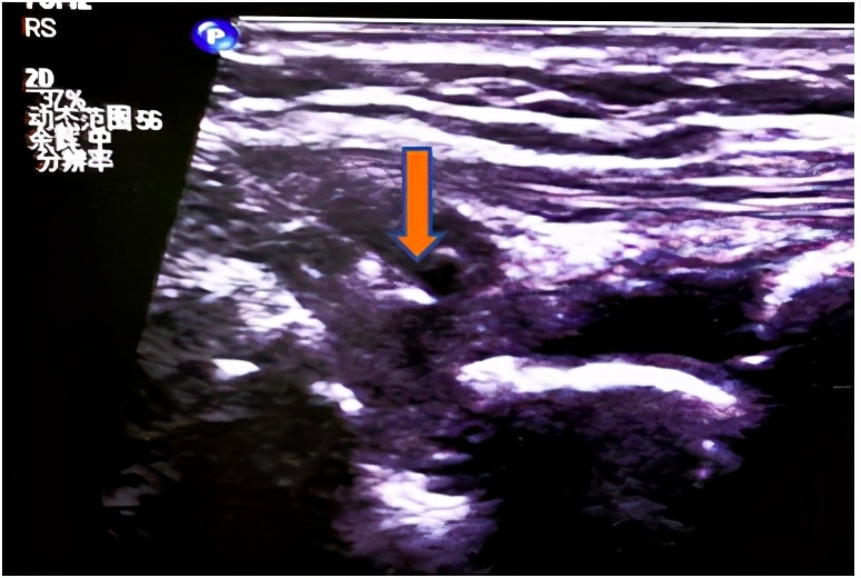 手腕疼痛需要拍片子吗,手腕肿痛ct可以查吗
