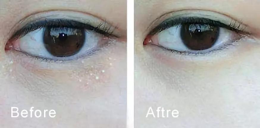 脂肪粒别用针挑教你一个土办法,脂肪粒怎么用针挑出来不疼