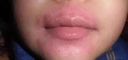 嘴唇干裂爆皮治疗的视频,嘴唇干裂爆皮用什么药