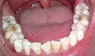 孩子牙龈炎吃什么消炎药,孩子严重牙龈炎怎么治疗