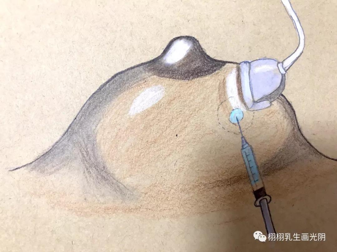 乳腺囊肿是什么意思严重吗,乳腺囊肿的由来