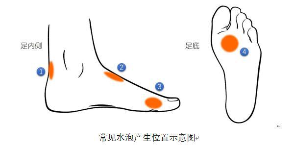 痛风脚底长水泡是什么原因,脚底疼肿是怎么回事