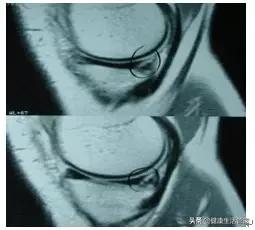 膝关节半月板撕裂怎么治,膝关节损伤科普知识
