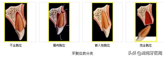 小朋友牙齿撞坏了怎么办,儿童牙齿摔掉了门牙怎么处理