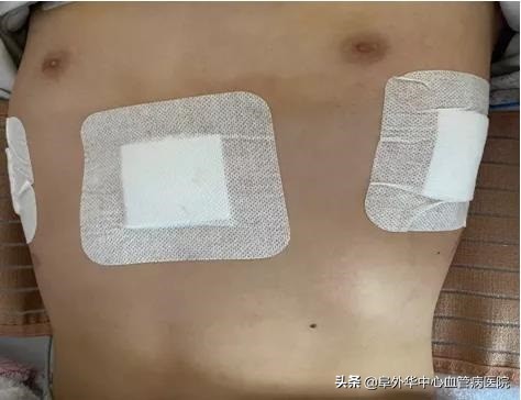 漏斗胸鸡胸矫正术,少年漏斗胸非手术治疗办法