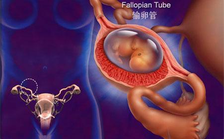 辟谣：B超检查发现盆腔积液，需要治疗？妇科医生：不要盲目处理