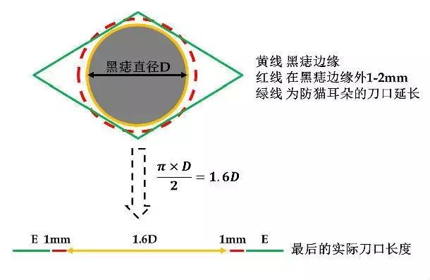 黑痣要去掉吗？专家和你聊聊关于“黑痣”的那些事儿