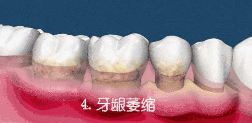 牙龈肿痛牙龈出血是否是病,为什么一上火牙龈就出血